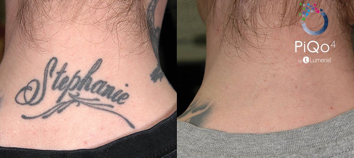 Laser Tattoo Removal Toronto  See Before  Afters  SpaMedica
