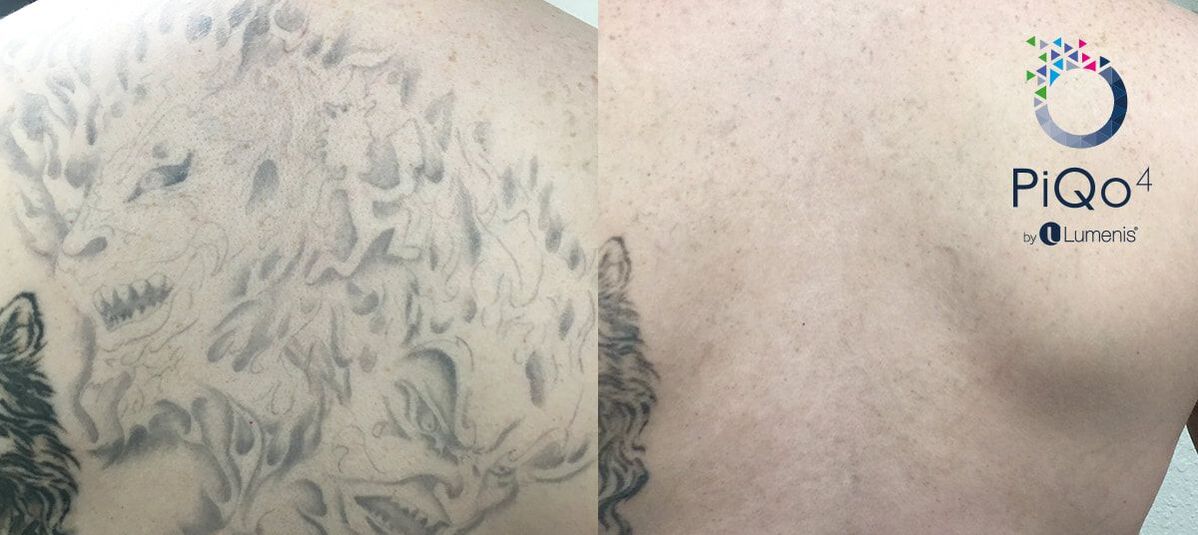 Laser Tattoo Removal - Butterfly Medical Spa